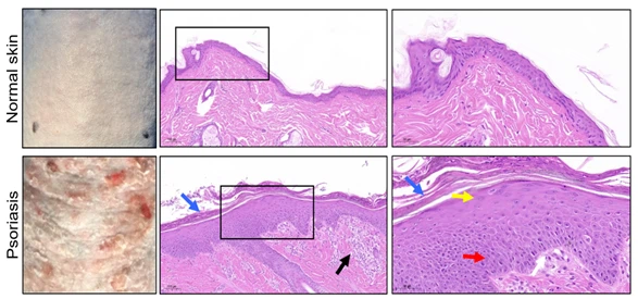 Psoriasis Model of monkey Psoriasis Model of monkey